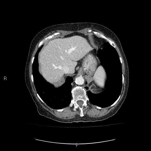 File:Adrenal collision tumor (ACT) (Radiopaedia 48462-53379 Axial C+ portal venous phase 8).jpg