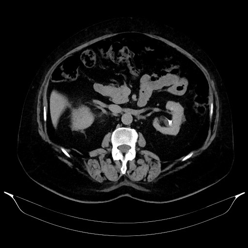 Adrenal cortical carcinoma (Radiopaedia 64017-72769 Axial C+ delayed 31).jpg
