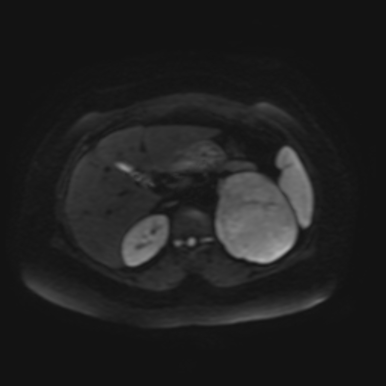 Adrenal cortical carcinoma (Radiopaedia 70906-81116 Axial DWI 10).jpg