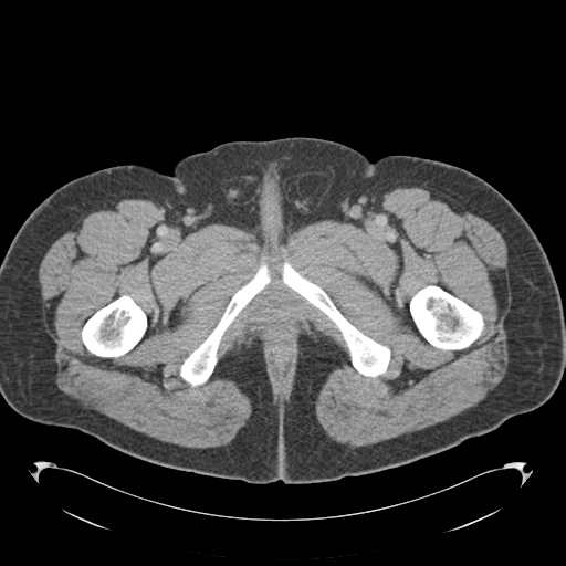 Adrenal cyst (Radiopaedia 45625-49776 Axial C+ portal venous phase 105).png