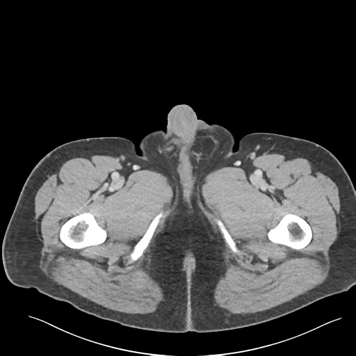 Adrenal cyst (Radiopaedia 45625-49777 Axial C+ portal venous phase 112).png