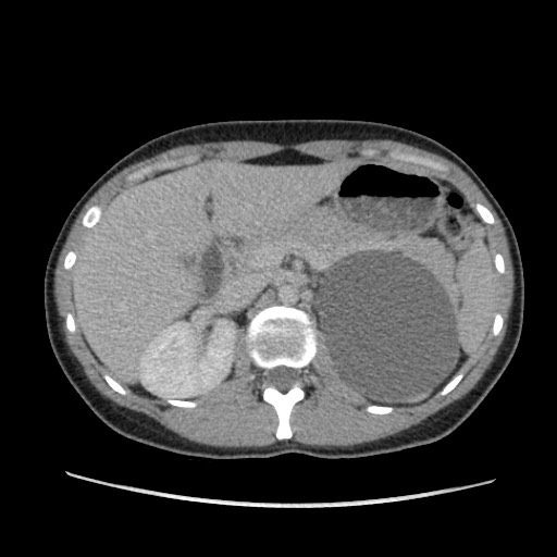 Adrenal cyst (Radiopaedia 64869-73813 Axial C+ portal venous phase 25).jpg