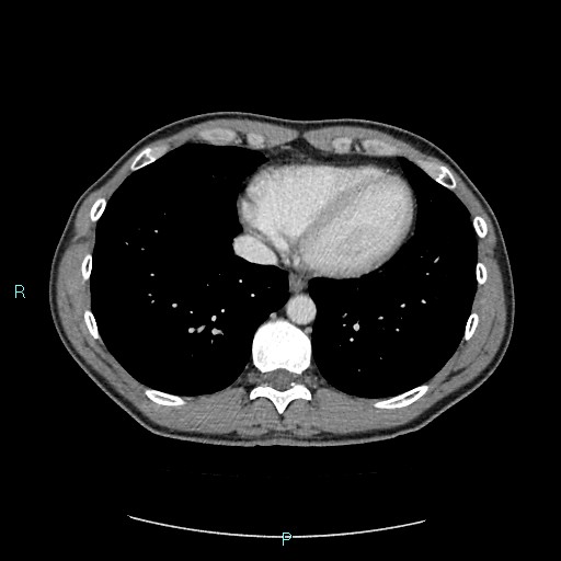 Adrenal cystic lymphangioma (Radiopaedia 83161-97534 Axial C+ portal venous phase 6).jpg