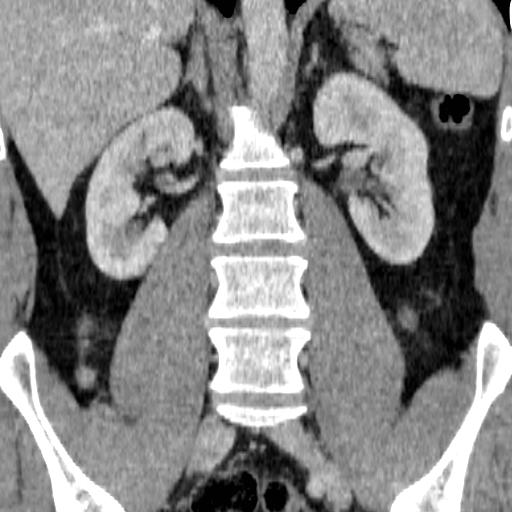 File:Adrenal glands (normal CT anatomy) (Radiopaedia 16570-105725 Coronal 8).jpg