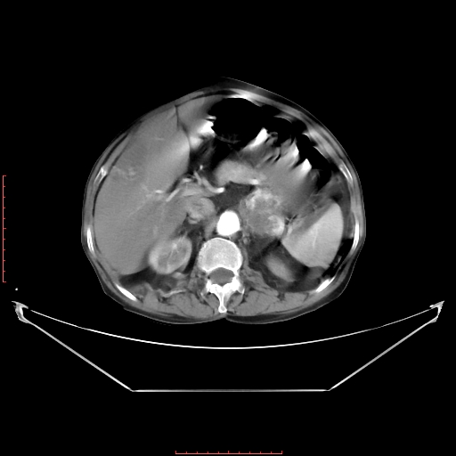 Adrenal hemangioma (Radiopaedia 68923-78668 Axial C+ arterial phase 28).jpg