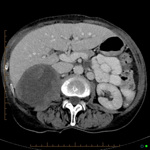 File:Adrenal metastasis from small cell lung cancer (Radiopaedia 19133-19108 Axial C+ portal venous phase 1).jpg