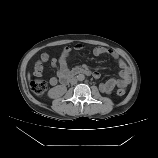 File:Adrenal myelolipoma (Radiopaedia 41843-44834 Axial non-contrast 39).jpg