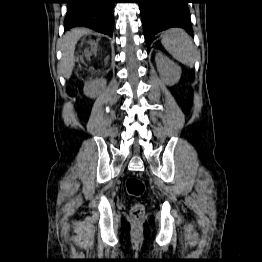 File:Adrenal myelolipoma (Radiopaedia 41843-44834 Coronal non-contrast 18).jpg