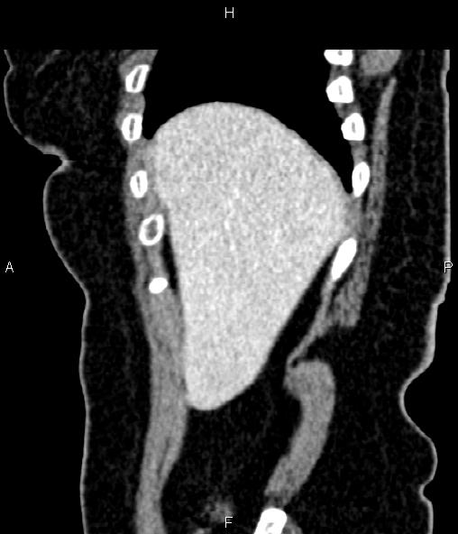File:Adrenal myelolipoma (Radiopaedia 82742-96986 Sagittal renal cortical phase 19).jpg