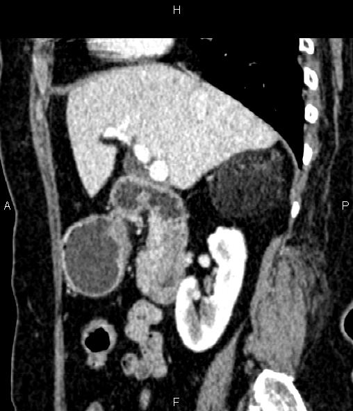 Adrenal myelolipoma (Radiopaedia 82742-96986 Sagittal renal cortical phase 43).jpg