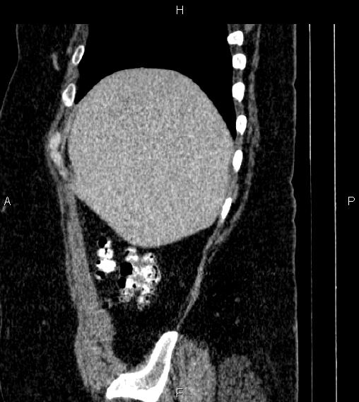 Adrenal myelolipoma (Radiopaedia 84319-99617 Sagittal renal cortical phase 13).jpg