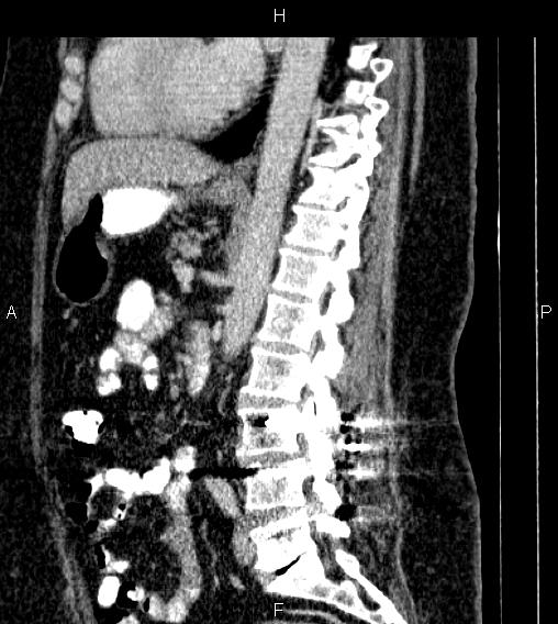 Adrenal myelolipoma (Radiopaedia 84319-99617 Sagittal renal cortical phase 53).jpg