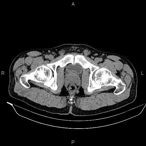 Adrenal myelolipoma (Radiopaedia 87794-104246 Axial non-contrast 106).jpg