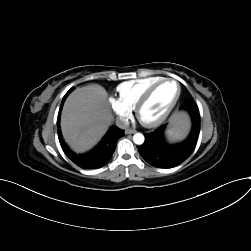 Adrenocortical carcinoma (Radiopaedia 87281-103569 Axial C+ arterial phase 10).jpg