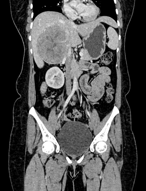 Adrenocortical carcinoma (Radiopaedia 87281-103569 Coronal C+ portal venous phase 35).jpg