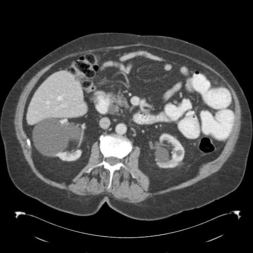 Adult ileal intussusception with secondary obstruction (Radiopaedia 30395-31051 Axial C+ portal venous phase 33).jpg