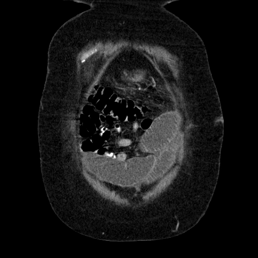 File:Afferent loop syndrome - secondary to incarcerated trocar site hernia (Radiopaedia 82959-97305 Coronal C+ portal venous phase 34).jpg