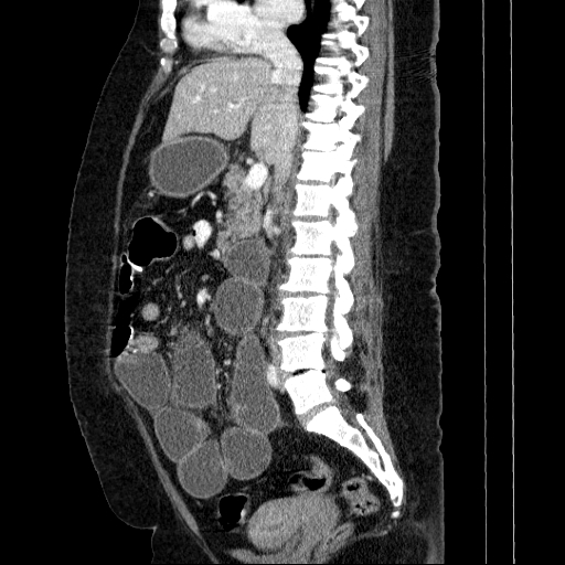 Afferent loop syndrome - secondary to incarcerated trocar site hernia (Radiopaedia 82959-97305 Sagittal C+ portal venous phase 83).jpg