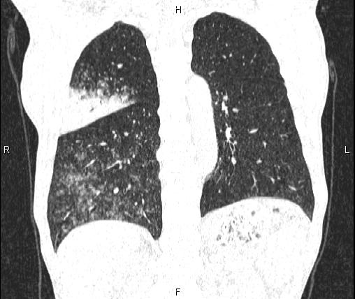 Air bronchogram in pneumonia (Radiopaedia 85719-101512 Coronal lung window 42).jpg