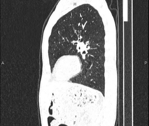 Air bronchogram in pneumonia (Radiopaedia 85719-101512 Sagittal lung window 68).jpg