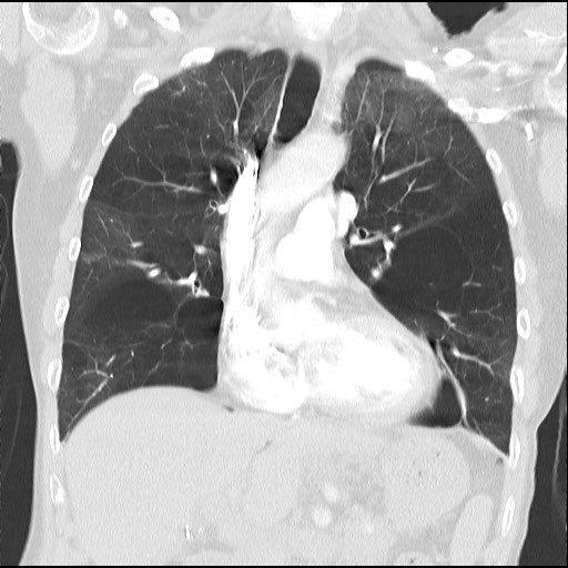 File:Alpha-1-antitrypsin deficiency (Radiopaedia 64893-73840 Coronal lung window 15).jpg