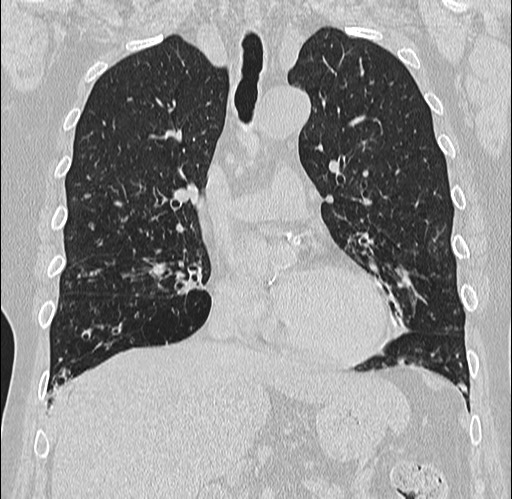 Alpha-1-antitrypsin deficiency (Radiopaedia 72058-82557 Coronal lung window 32).jpg