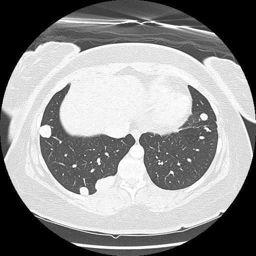 Alveolar soft part sarcoma - right leg (Radiopaedia 59432-67091 Axial lung window 88).jpg