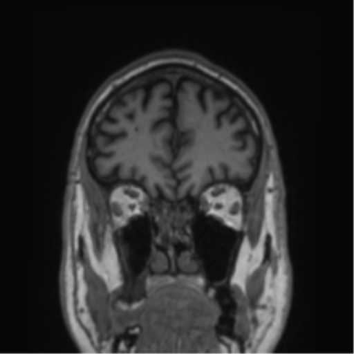 Alzheimer's disease- with Gerstmann syndrome and dressing apraxia (Radiopaedia 54882-61150 Coronal T1 73).png