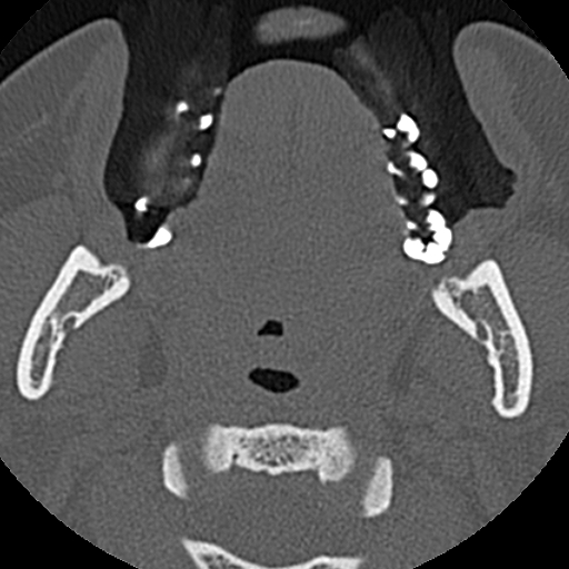 Ameloblastic fibro-odontoma (Radiopaedia 18843-18780 C 59).jpg
