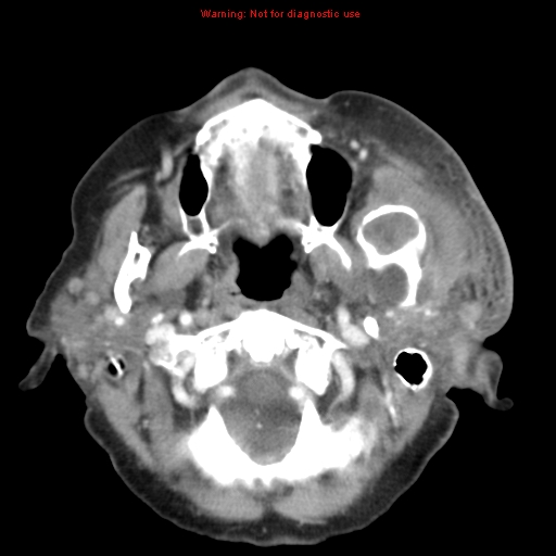 Ameloblastoma (Radiopaedia 27437-27631 A 24).jpg
