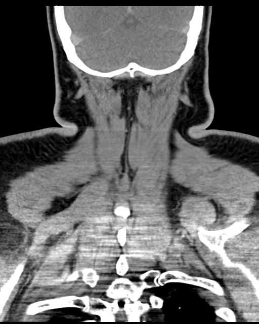 Ameloblastoma (Radiopaedia 38520-40623 Coronal non-contrast 66).png