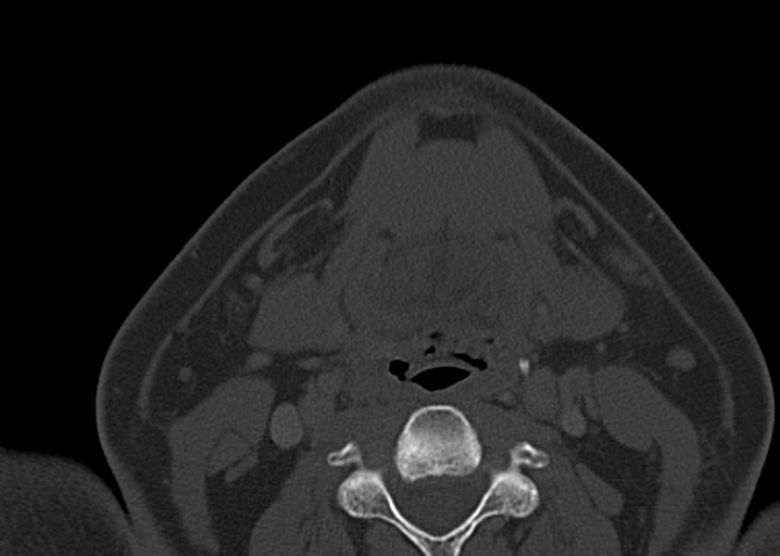 File:Ameloblastoma (Radiopaedia 38520-40623 D 41).png