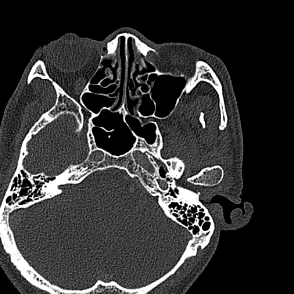 Ameloblastoma (Radiopaedia 51921-57766 Axial bone window 155).jpg