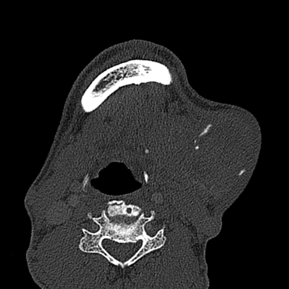 Ameloblastoma (Radiopaedia 51921-57766 Axial bone window 26).jpg