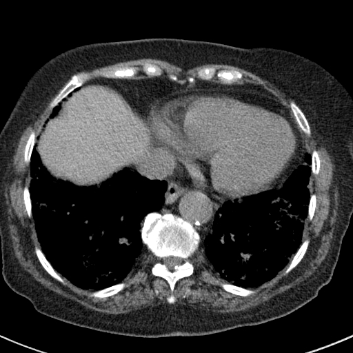 Amiodarone-induced pulmonary fibrosis (Radiopaedia 82355-96460 Axial non-contrast 46).jpg