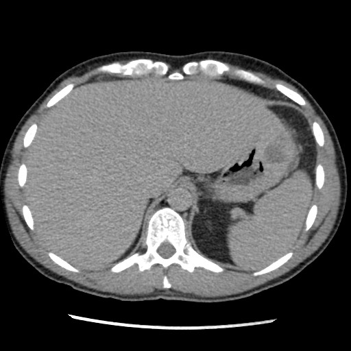 Amoebic liver abscesses (Radiopaedia 55536-62009 Axial C+ delayed 19).jpg