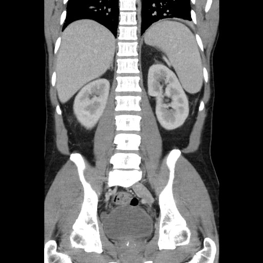 Amoebic liver abscesses (Radiopaedia 55536-62009 B 35).jpg