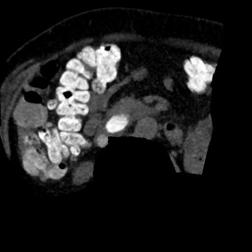 Ampullary adenocarcinoma (Radiopaedia 34013-35241 AXIAL MIPS 3-1.5 86).png