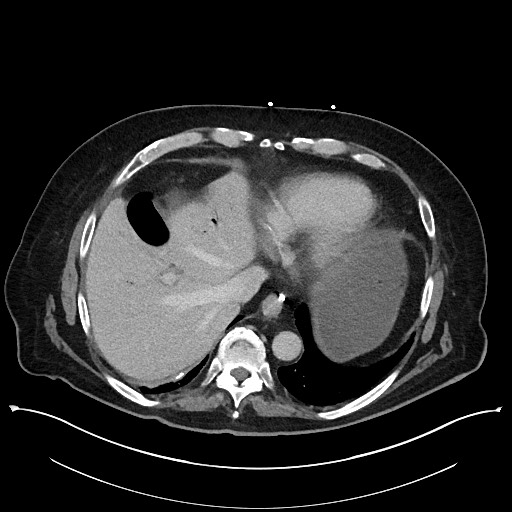 Ampullary adenocarcinoma (Radiopaedia 59373-66737 A 30).jpg