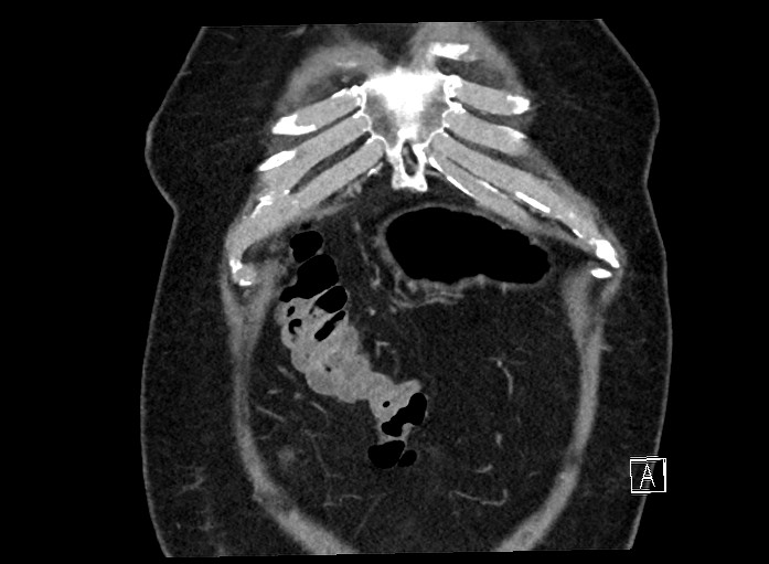 Ampullary adenocarcinoma (Radiopaedia 59373-66737 B 11).jpg