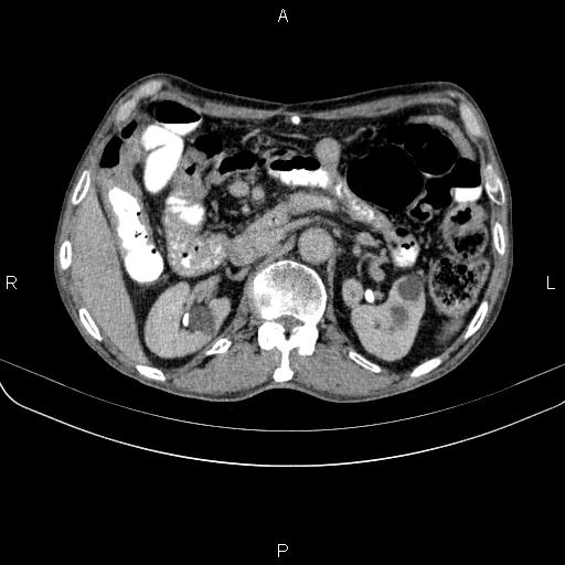 Ampullary adenocarcinoma (Radiopaedia 86093-102033 Axial C+ delayed 43).jpg