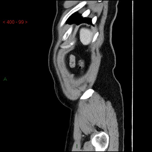 File:Ampullary carcinoma (Radiopaedia 56396-63056 D 98).jpg