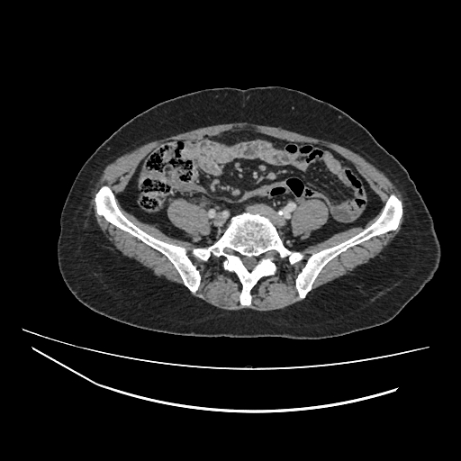 File:Ampullary tumor (Radiopaedia 60333-67998 A 61).jpg