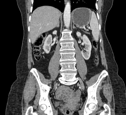 Ampullary tumor (Radiopaedia 60333-67998 B 48).jpg