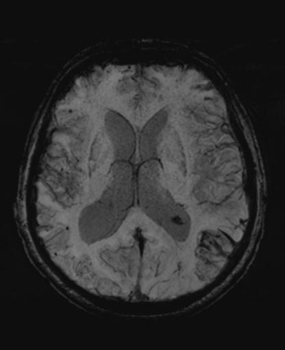 File:Amyloid angiopathy with inflammation (Radiopaedia 30360-31002 Axial SWI MIP 31).jpg