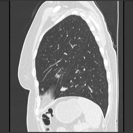 Amyloidosis - bronchial and diffuse nodular pulmonary involvement (Radiopaedia 60156-67744 F 44).jpg