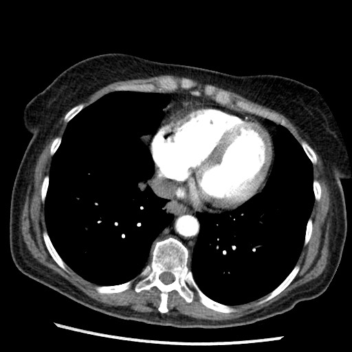 Amyloidosis - bronchial and diffuse nodular pulmonary involvement (Radiopaedia 60156-67745 A 38).jpg