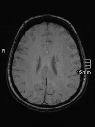 Amyotrophic lateral sclerosis (Radiopaedia 70821-81017 Axial SWI 35).jpg