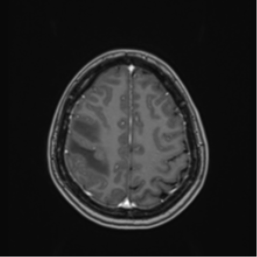 Anaplastic astroblastoma (Radiopaedia 55666-62194 Axial T1 C+ 59).png