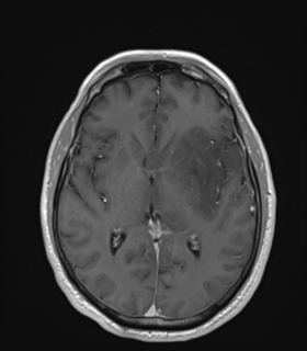 Anaplastic astrocytoma IDH wild-type (Radiopaedia 49984-55273 Axial T1 C+ 30).png